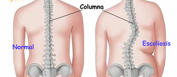 Asimetría postural y escoliosis funcional frente a alineación neutra