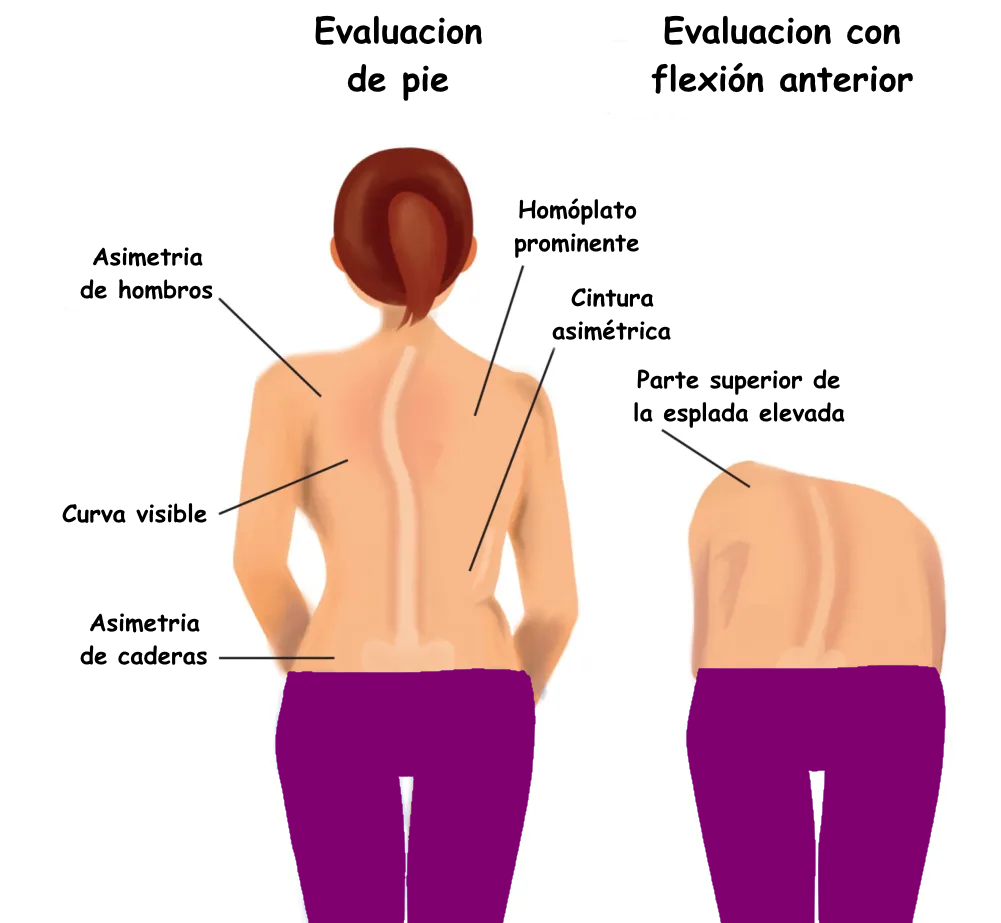 Comparación de asimetría funcional frente a postura equilibrada