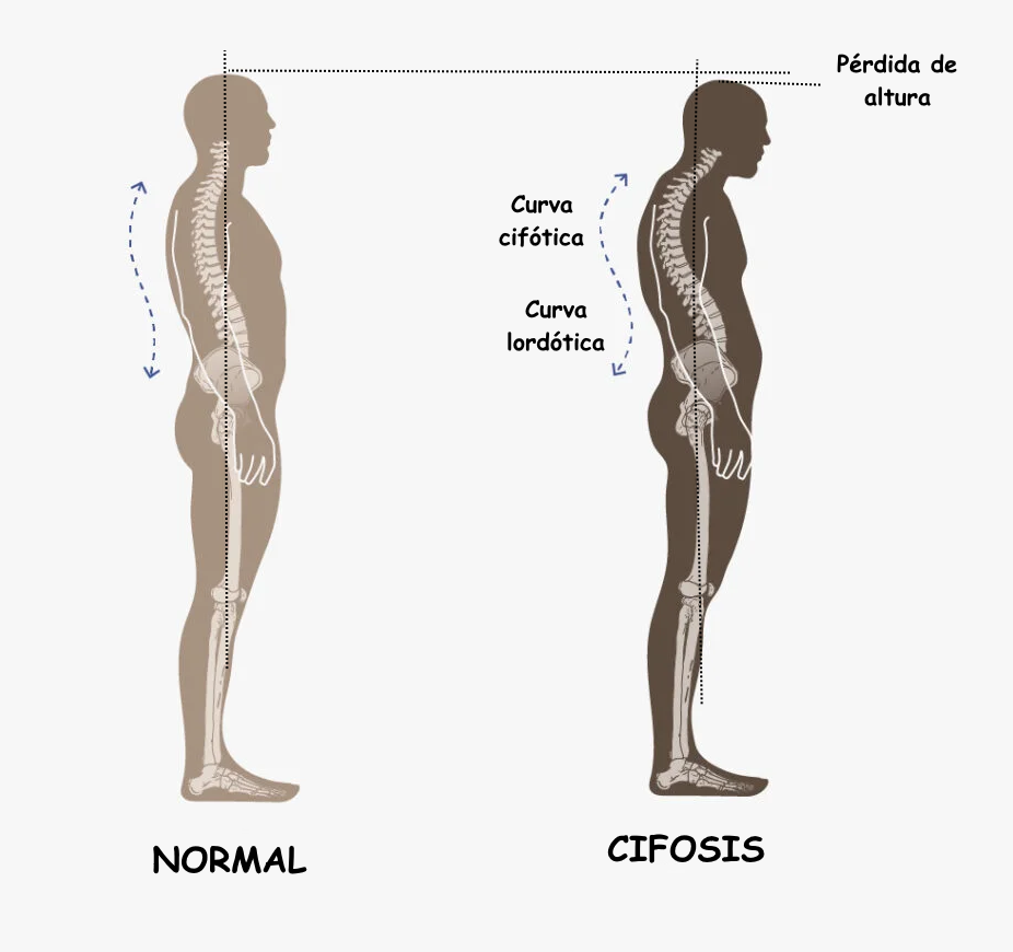 Comparación en vista lateral: espalda alta encorvada frente a postura con tórax más extendido
