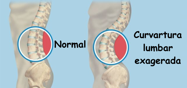 Hiperlordosis lumbar: curva lumbar exagerada y pelvis en anteversión frente a postura más neutra