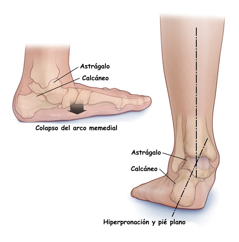Comparación: pie pronado frente a pie neutro