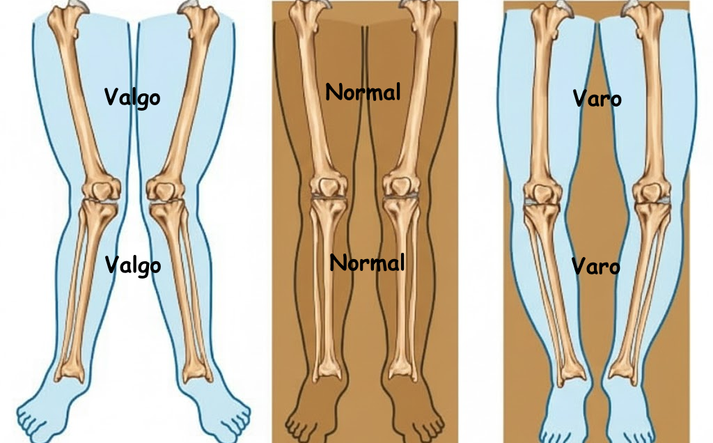 Valgo de rodilla: rodillas que colapsan hacia dentro frente a alineación neutra